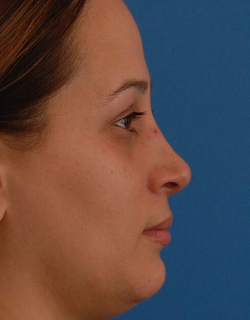 Revision Rhinoplasty Before & After Gallery - Patient 323439 - Image 1
