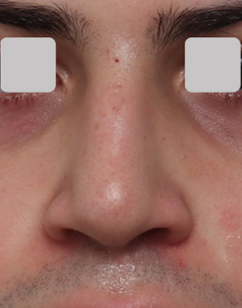 Non-Surgical Rhinoplasty Before & After Gallery - Patient 224837 - Image 4