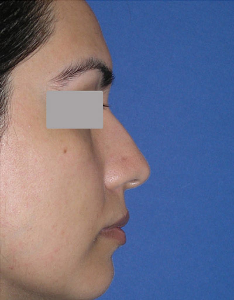 Foundation Rhinoplasty / Crooked Nose Before & After Gallery - Patient 278075 - Image 3