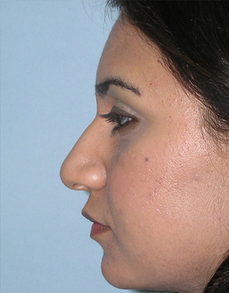 Patient ca2oBKmZSLa0YFOfO4lHMA - Ethnic Rhinoplasty Before & After Photos