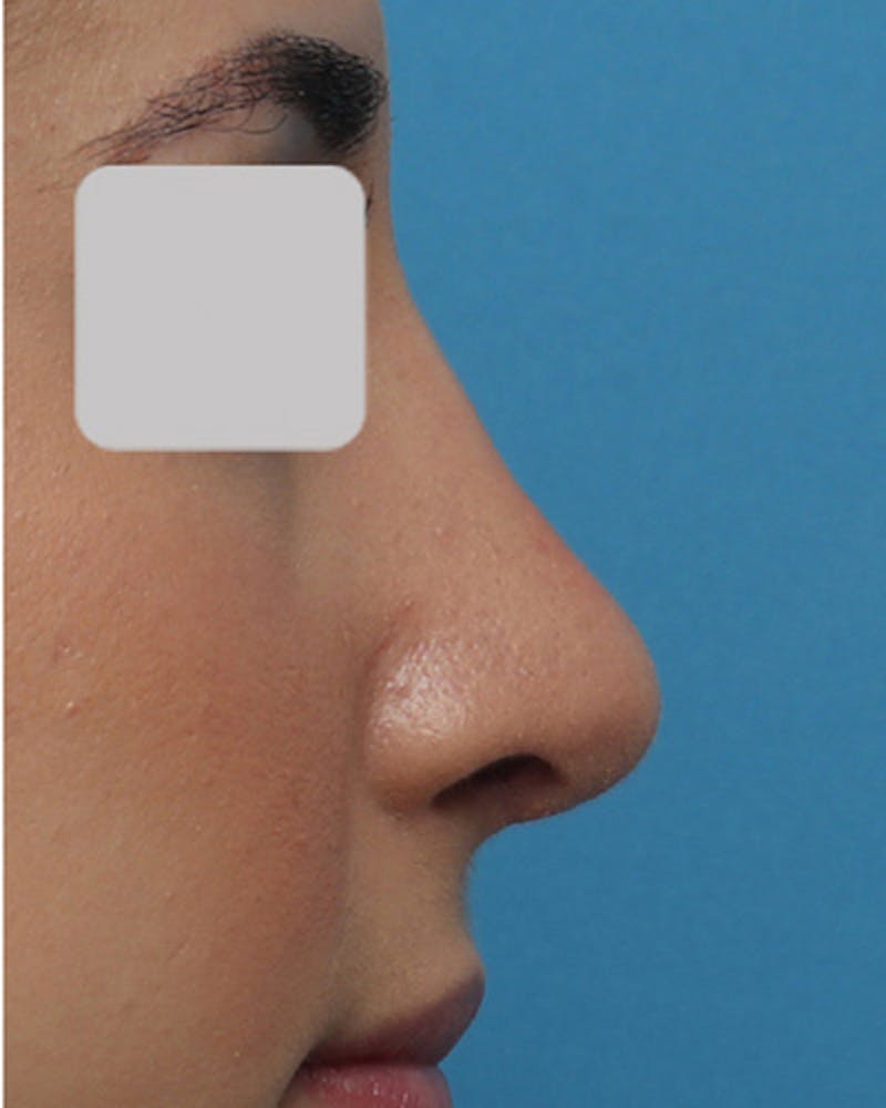 Rhinoplasty Before & After Gallery - Patient 799614 - Image 2