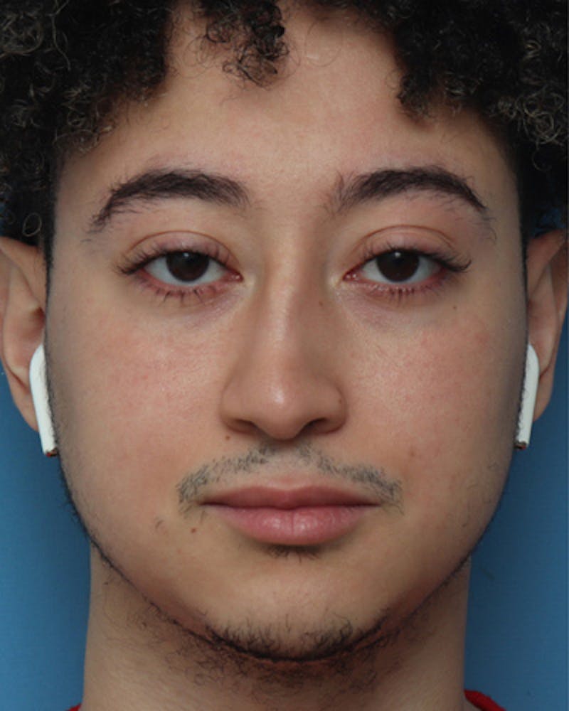 Male Rhinoplasty Before & After Gallery - Patient 346574 - Image 3