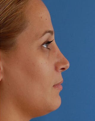 Rhinoplasty Before & After Gallery - Patient 366031 - Image 2