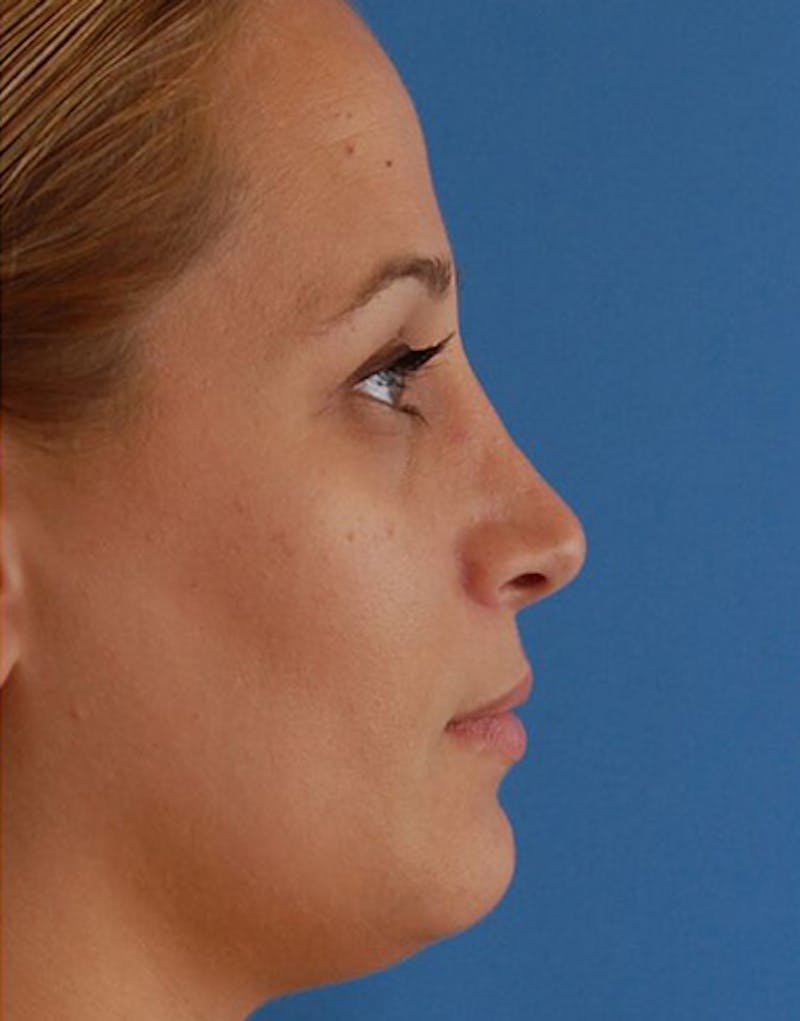 Revision Rhinoplasty Before & After Gallery - Patient 323439 - Image 2