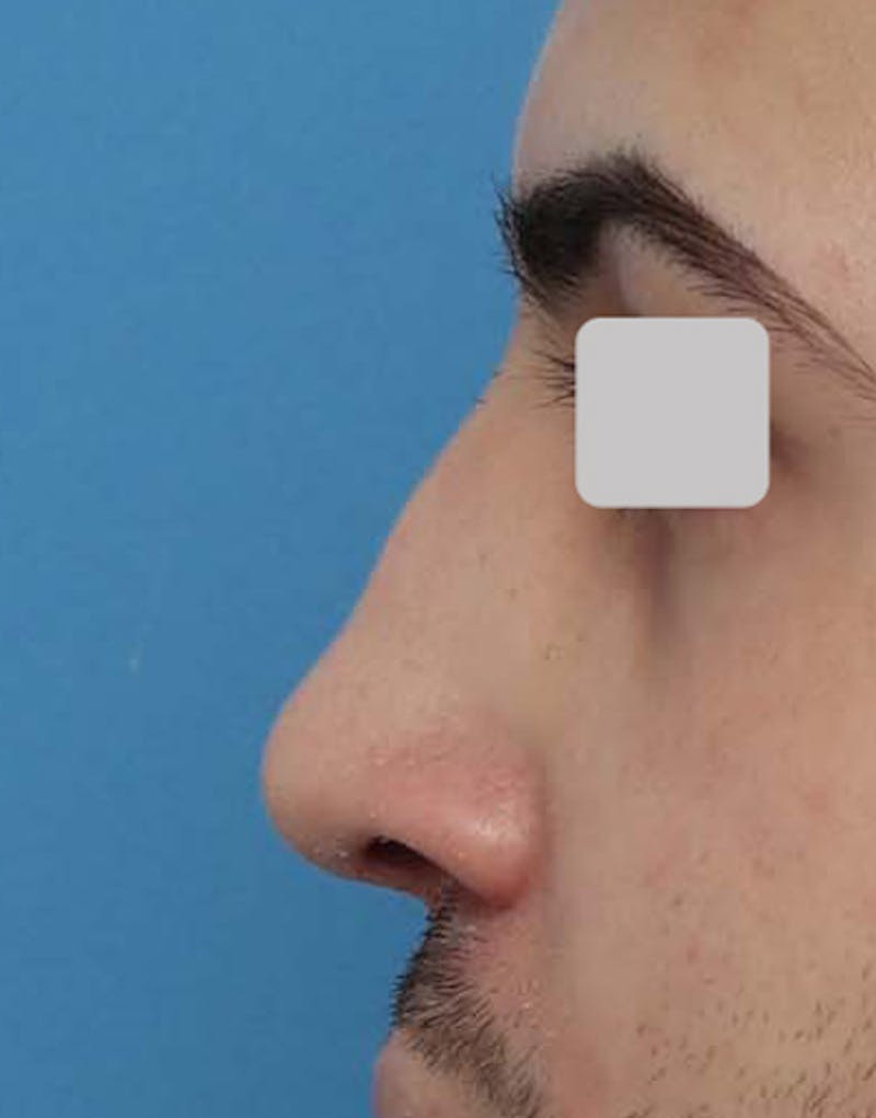 Non-Surgical Rhinoplasty Before & After Gallery - Patient 224837 - Image 1
