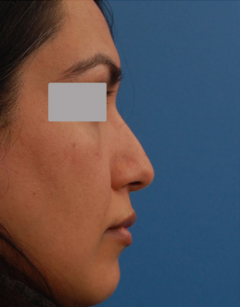 Foundation Rhinoplasty / Crooked Nose Before & After Gallery - Patient 278075 - Image 4