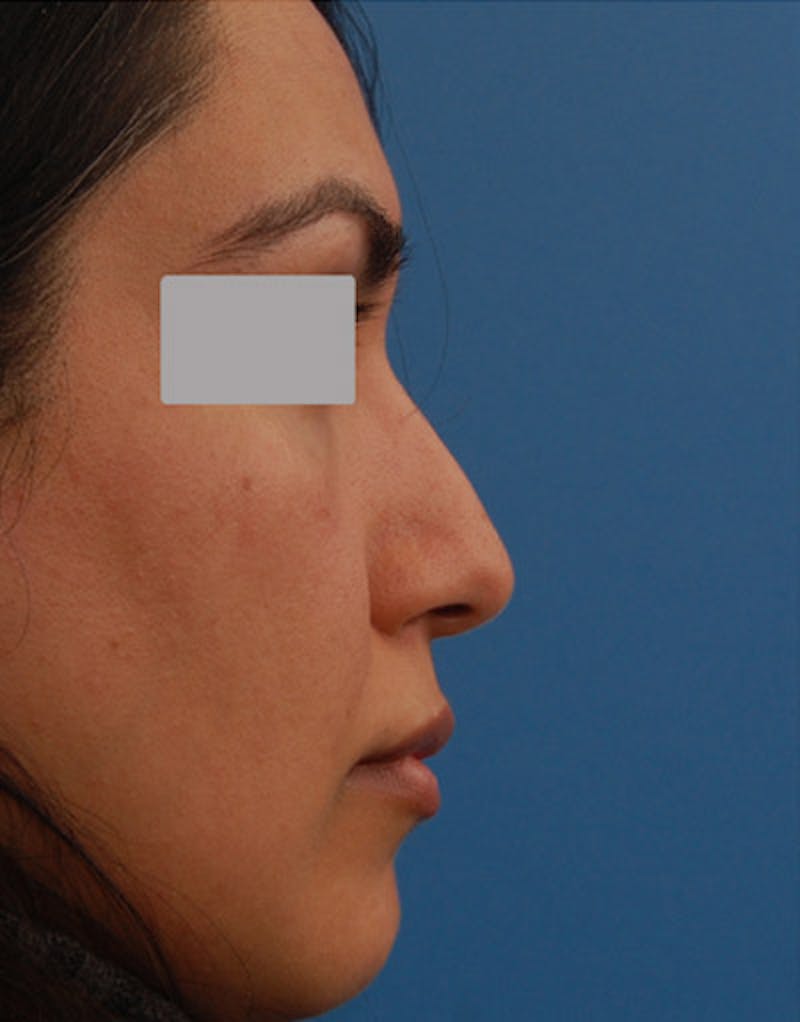 Rhinoplasty  Before & After Gallery - Patient 339353 - Image 4