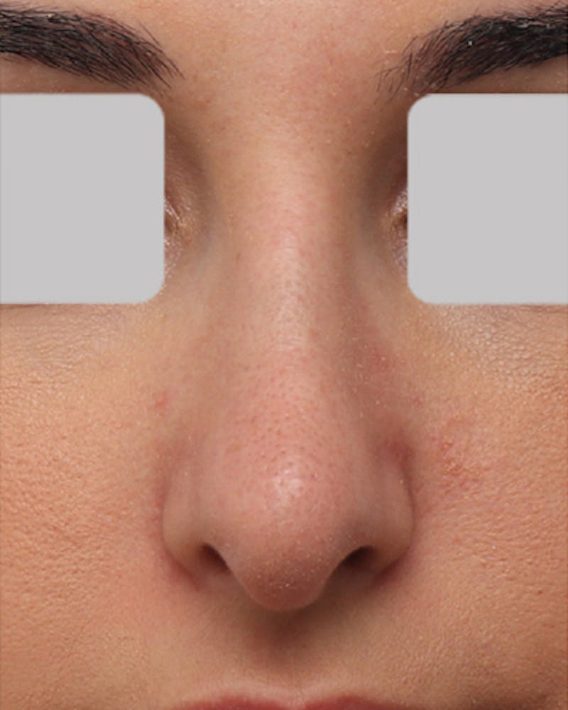 Rhinoplasty Before & After Gallery - Patient 799614 - Image 3