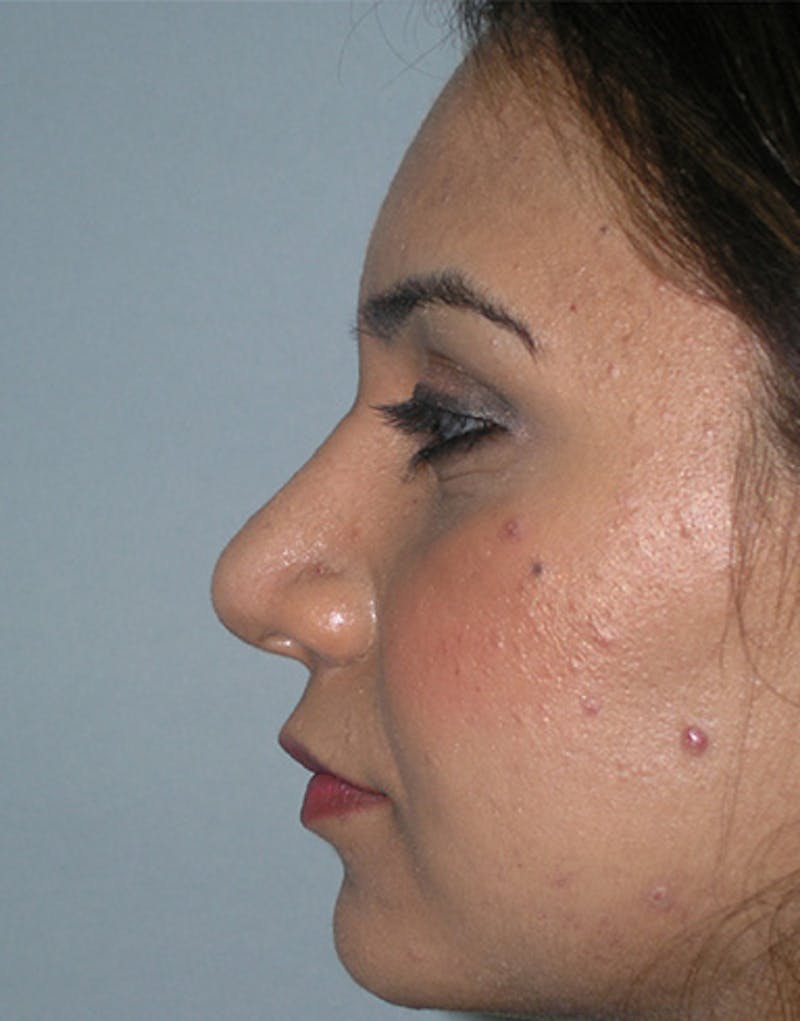 Ethnic Rhinoplasty Before & After Gallery - Patient 155884 - Image 2