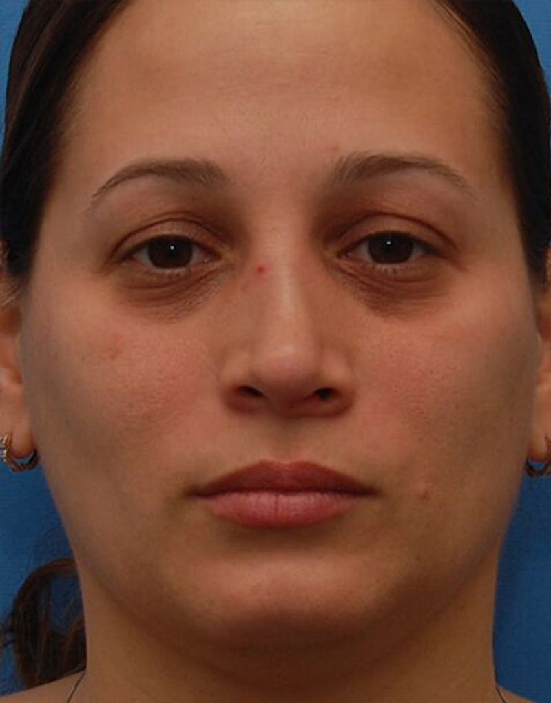 Rhinoplasty  Before & After Gallery - Patient 366031 - Image 3