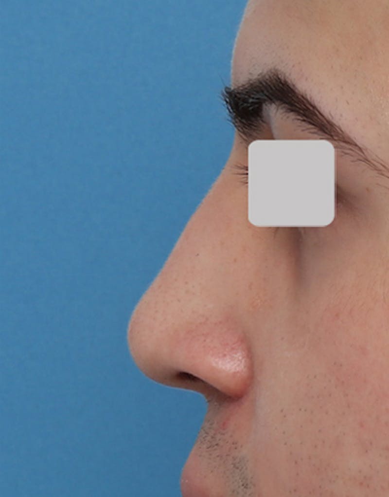 Non-Surgical Rhinoplasty Before & After Gallery - Patient 224837 - Image 2