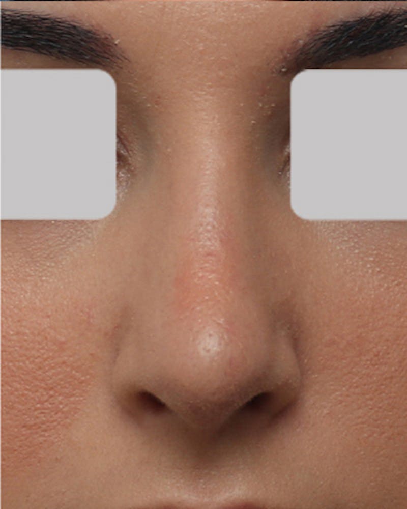 Rhinoplasty Before & After Gallery - Patient 799614 - Image 4