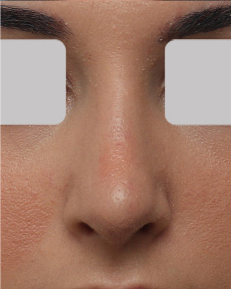 Rhinoplasty  Before & After Gallery - Patient 967799 - Image 4
