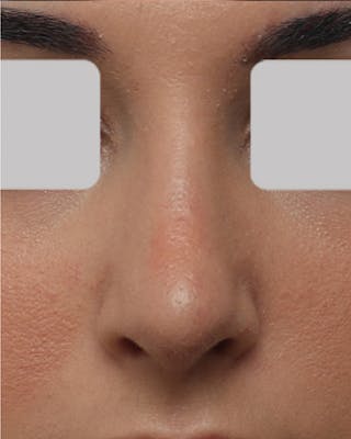 Rhinoplasty Before & After Gallery - Patient 967799 - Image 4