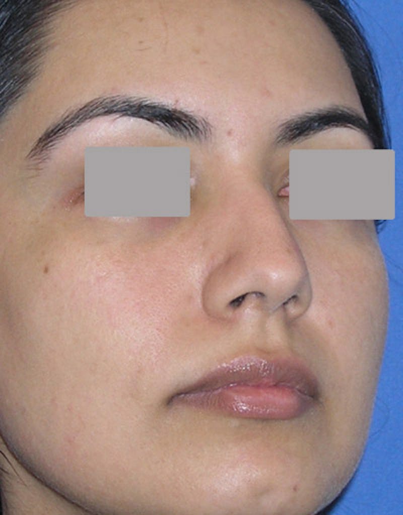 Foundation Rhinoplasty / Crooked Nose Before & After Gallery - Patient 278075 - Image 5