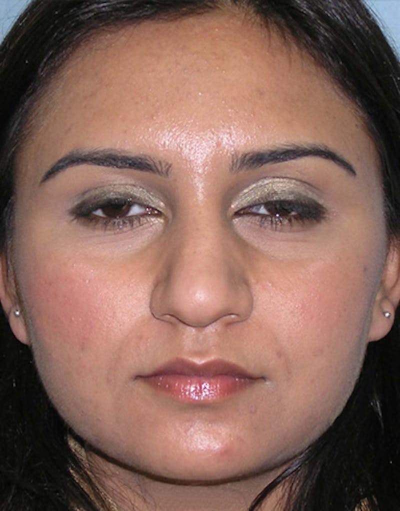 Ethnic Rhinoplasty Before & After Gallery - Patient 155884 - Image 3