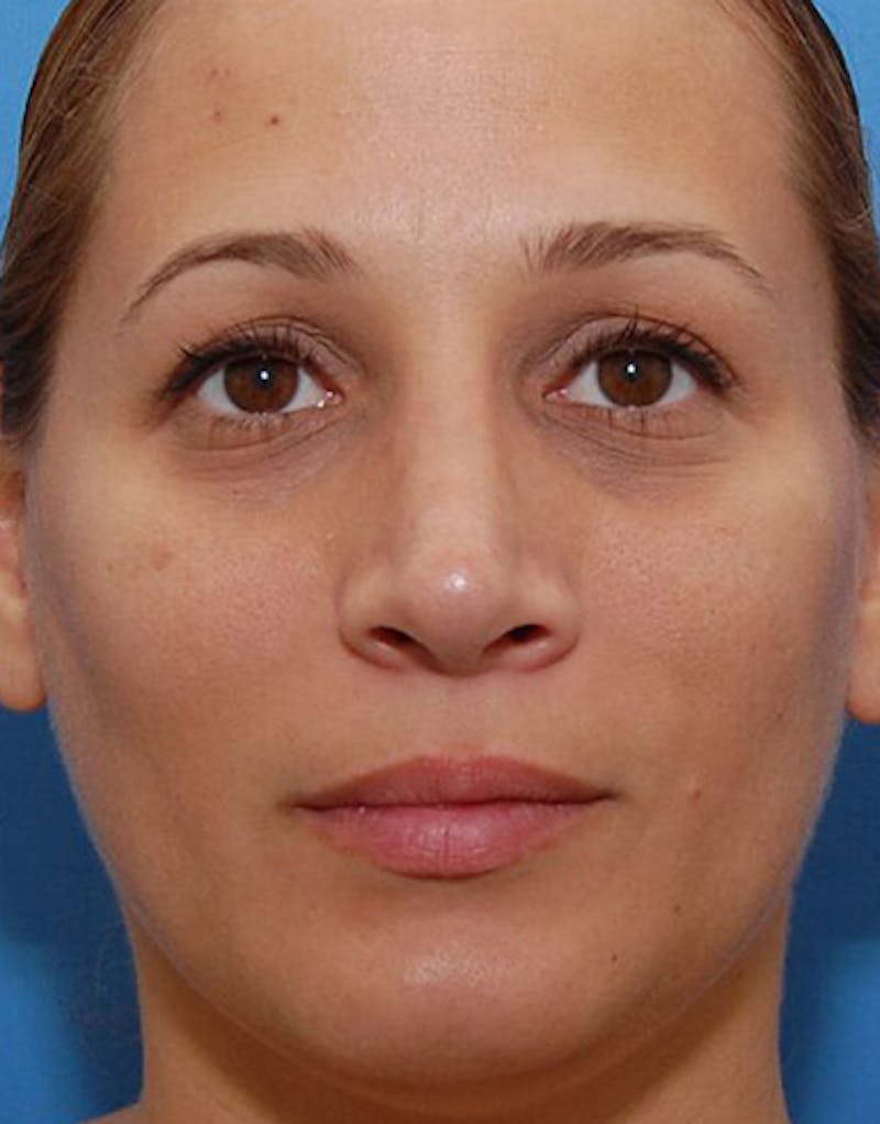 Revision Rhinoplasty Before & After Gallery - Patient 323439 - Image 4