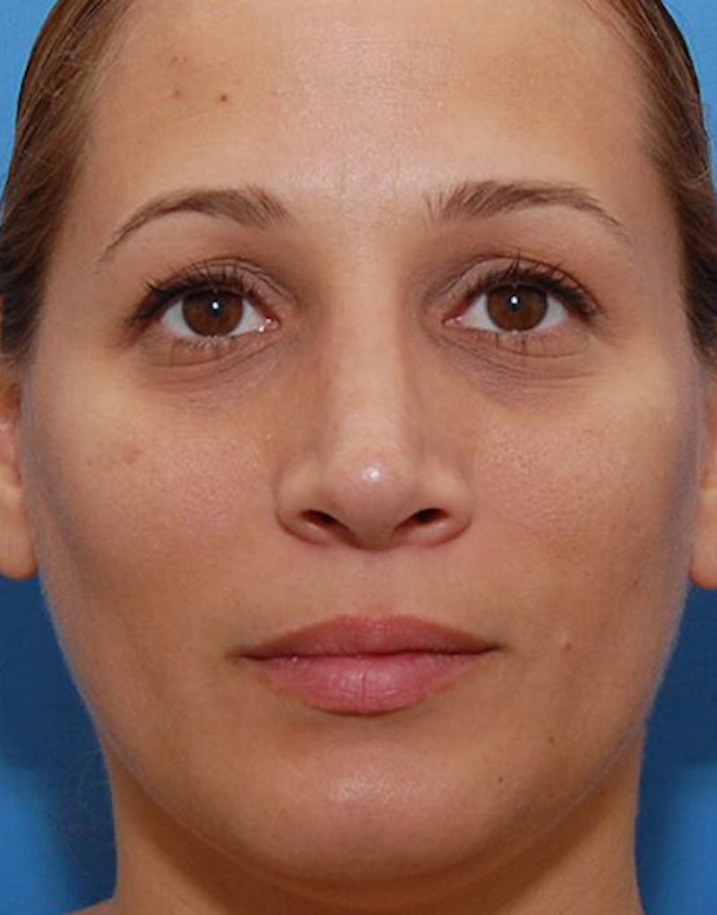 Rhinoplasty  Before & After Gallery - Patient 366031 - Image 4