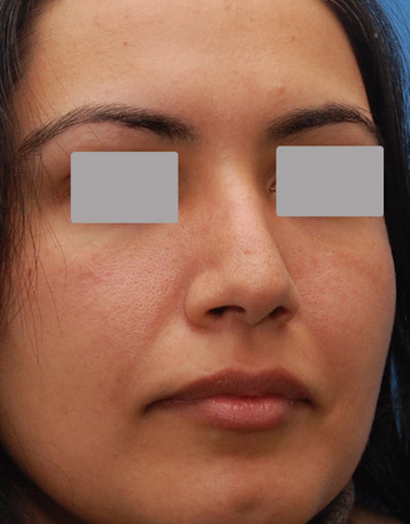 Foundation Rhinoplasty / Crooked Nose Before & After Gallery - Patient 278075 - Image 6