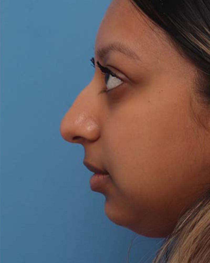 Rhinoplasty Before & After Gallery - Patient 564178 - Image 1