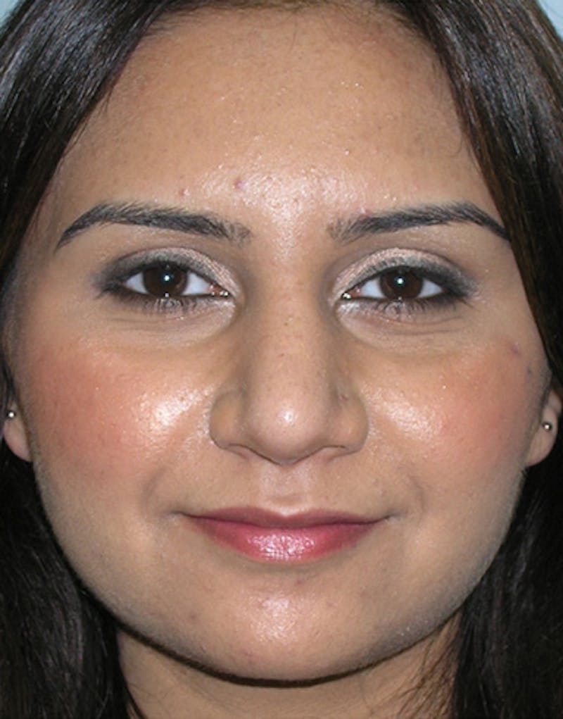Ethnic Rhinoplasty Before & After Gallery - Patient 155884 - Image 4