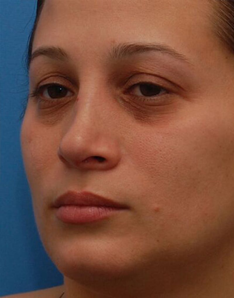 Rhinoplasty  Before & After Gallery - Patient 366031 - Image 5