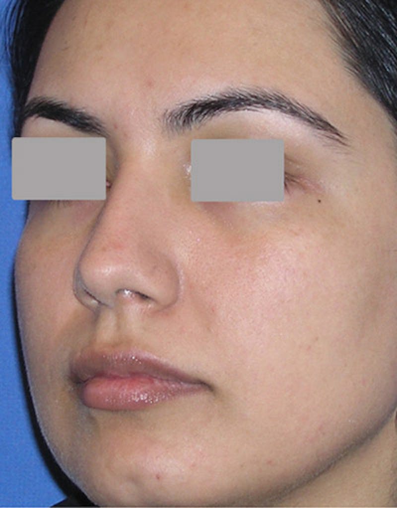 Foundation Rhinoplasty / Crooked Nose Before & After Gallery - Patient 278075 - Image 7