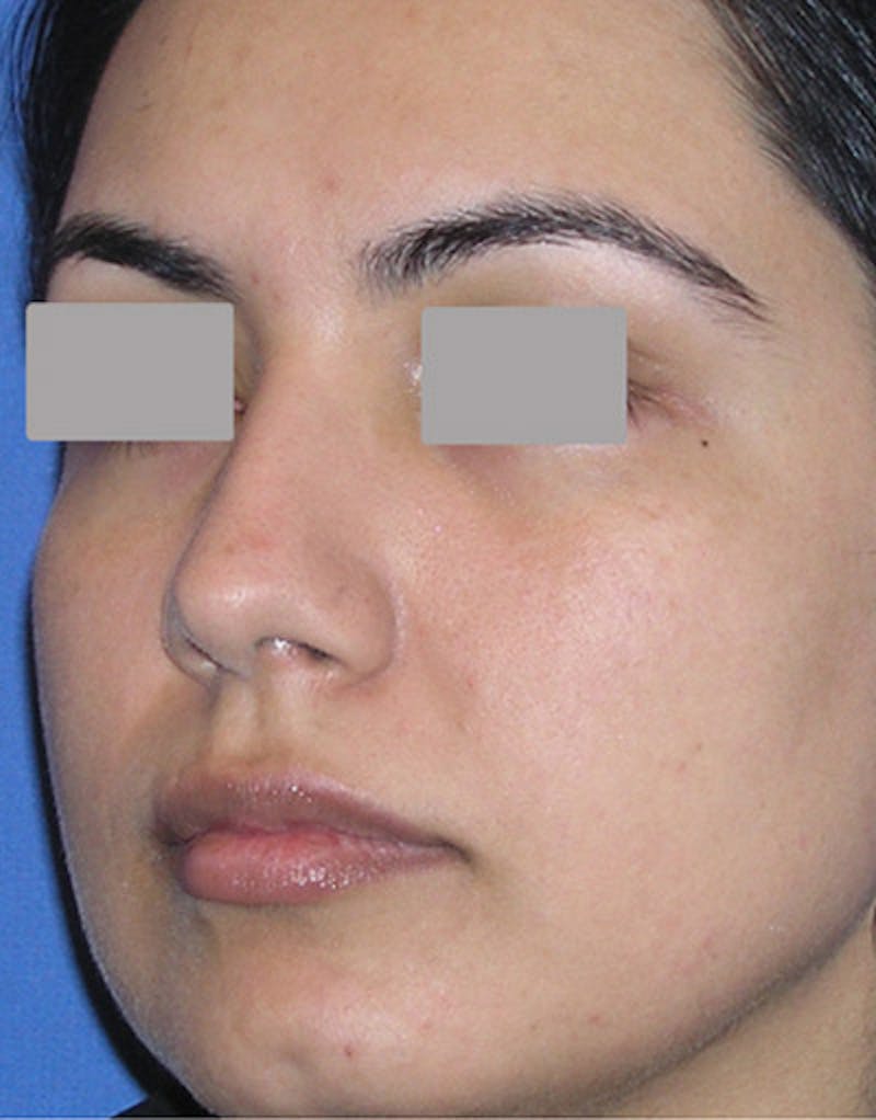 Rhinoplasty  Before & After Gallery - Patient 339353 - Image 7
