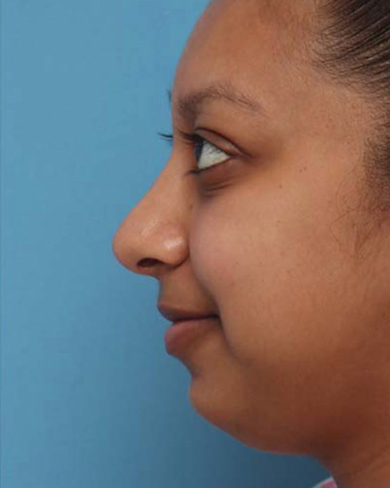 Rhinoplasty Before & After Gallery - Patient 564178 - Image 2