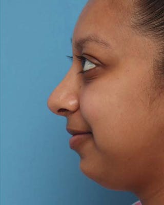 Rhinoplasty Before & After Gallery - Patient 233755 - Image 2
