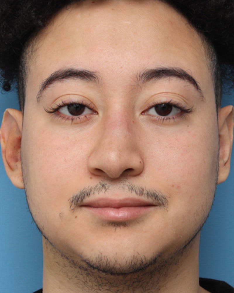 Rhinoplasty  Before & After Gallery - Patient 339588 - Image 4