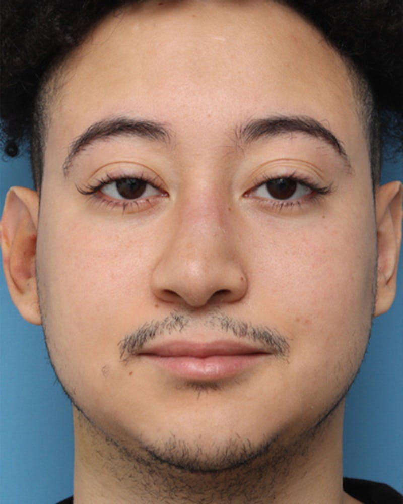 Male Rhinoplasty Before & After Gallery - Patient 346574 - Image 4