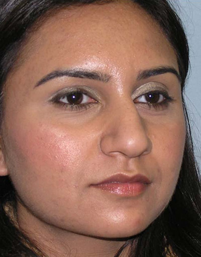 Rhinoplasty  Before & After Gallery - Patient 133931 - Image 5