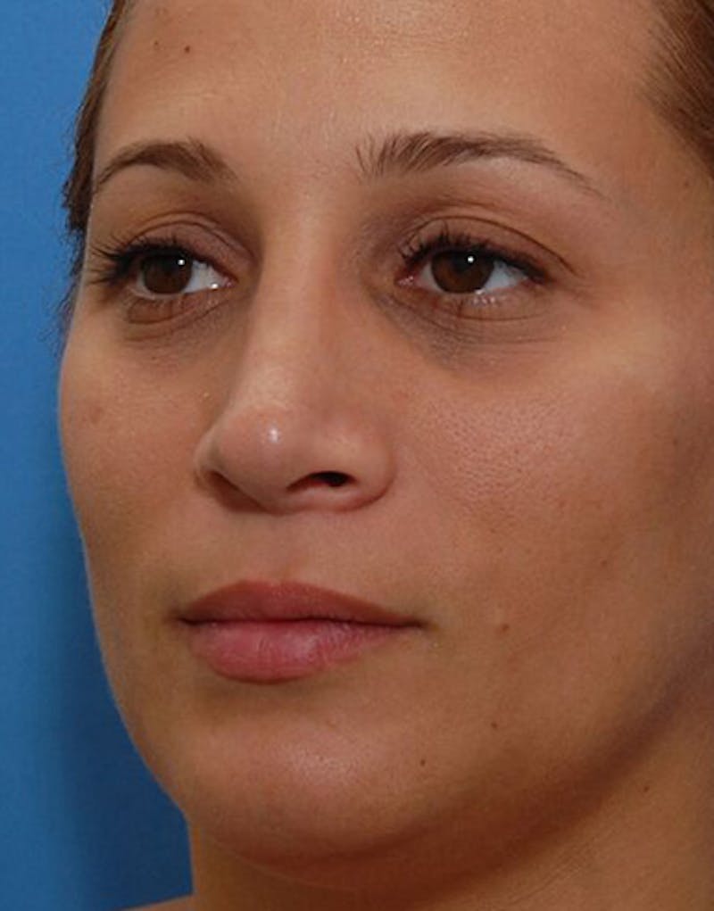 Rhinoplasty  Before & After Gallery - Patient 366031 - Image 6
