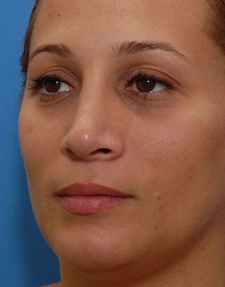 Rhinoplasty Before & After Gallery - Patient 366031 - Image 6