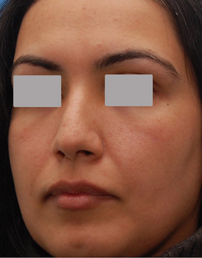 Foundation Rhinoplasty / Crooked Nose Before & After Gallery - Patient 278075 - Image 8