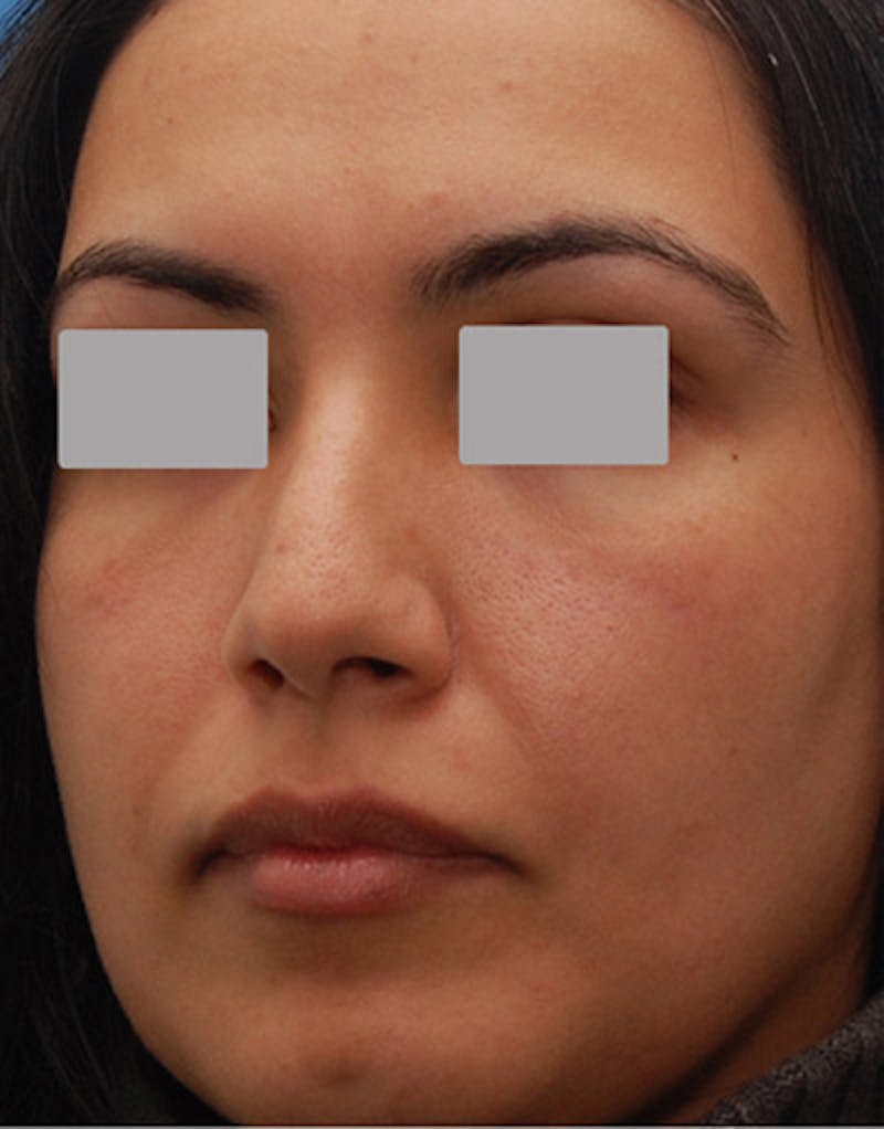 Rhinoplasty  Before & After Gallery - Patient 339353 - Image 8