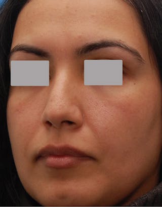 Favorite Foundation Rhinoplasty / Crooked Nose Before & After Gallery - Patient 240227 - Image 8