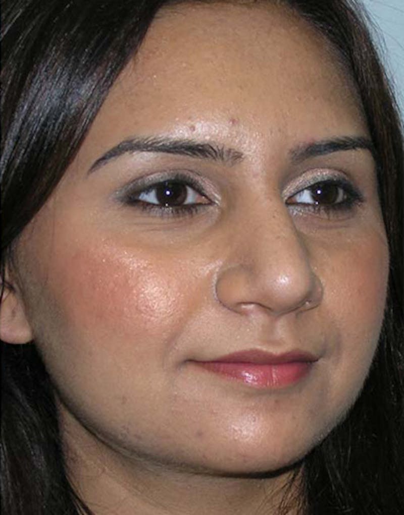 Rhinoplasty  Before & After Gallery - Patient 133931 - Image 6