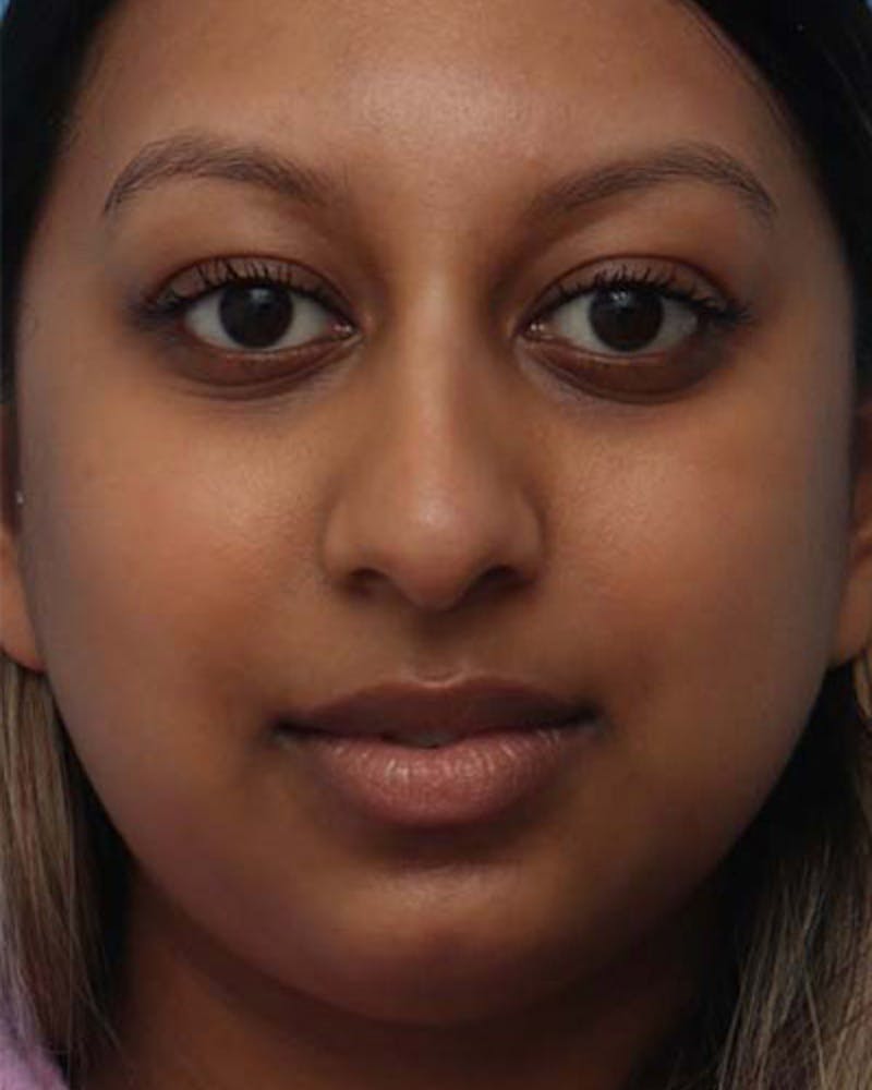 Rhinoplasty  Before & After Gallery - Patient 233755 - Image 3