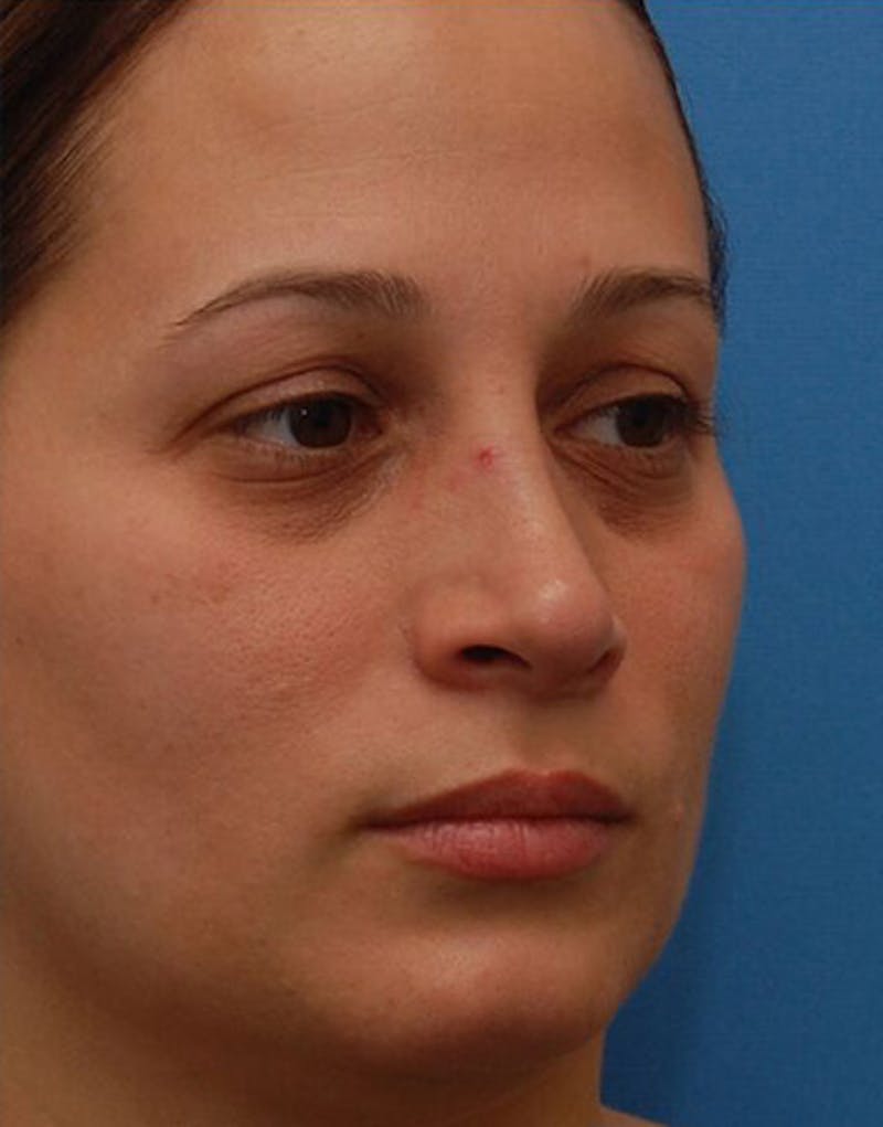 Revision Rhinoplasty Before & After Gallery - Patient 323439 - Image 7