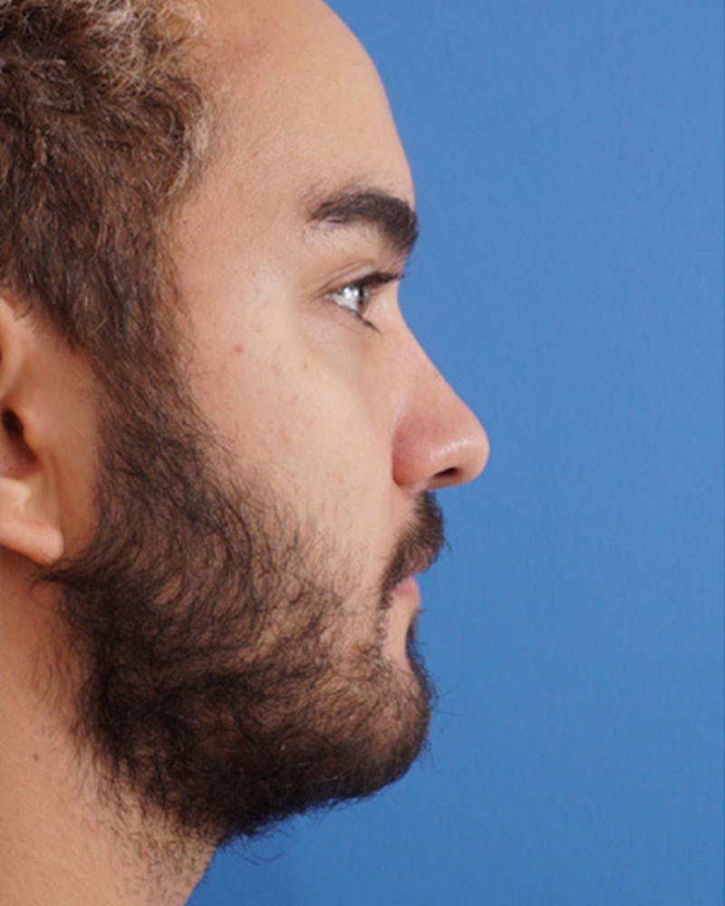 Patient GDegiIQgSymESL1yc9BcGw - Male Rhinoplasty Before & After Photos