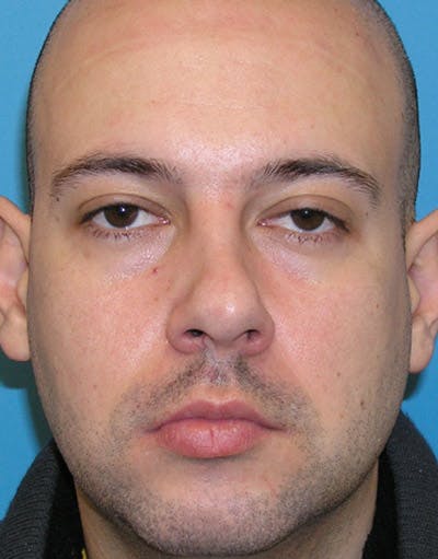 Rhinoplasty Before & After Gallery - Patient 332665 - Image 1