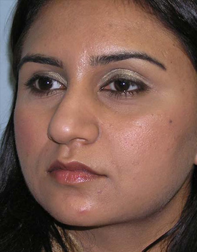 Ethnic Rhinoplasty Before & After Gallery - Patient 155884 - Image 7