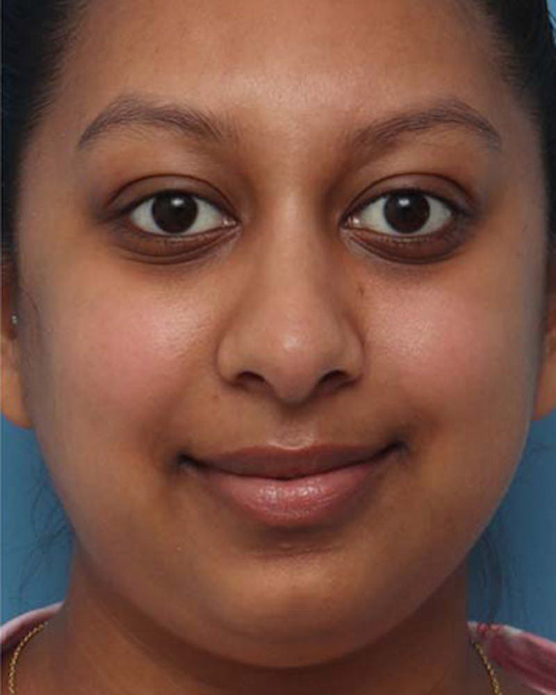 Rhinoplasty Before & After Gallery - Patient 564178 - Image 4