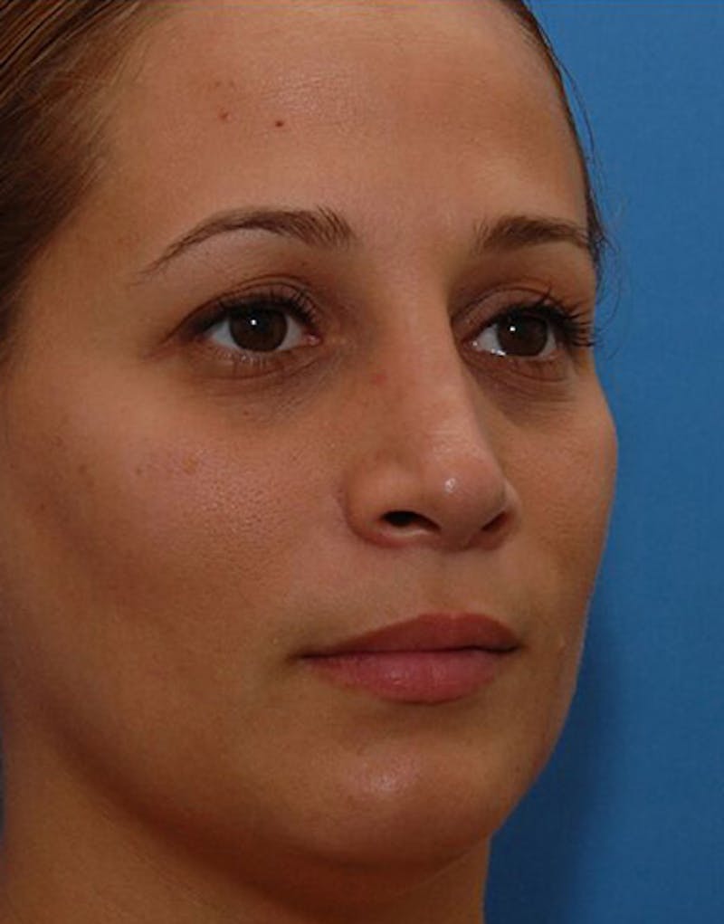 Revision Rhinoplasty Before & After Gallery - Patient 323439 - Image 8