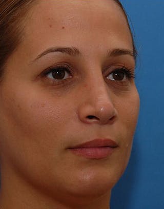 Rhinoplasty Before & After Gallery - Patient 366031 - Image 8