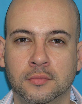 Rhinoplasty Before & After Gallery - Patient 332665 - Image 2