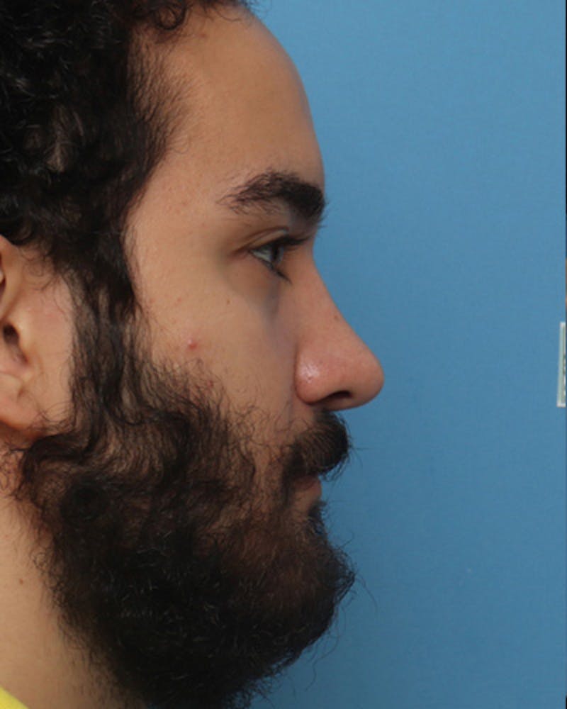 Male Rhinoplasty Before & After Gallery - Patient 373176 - Image 2