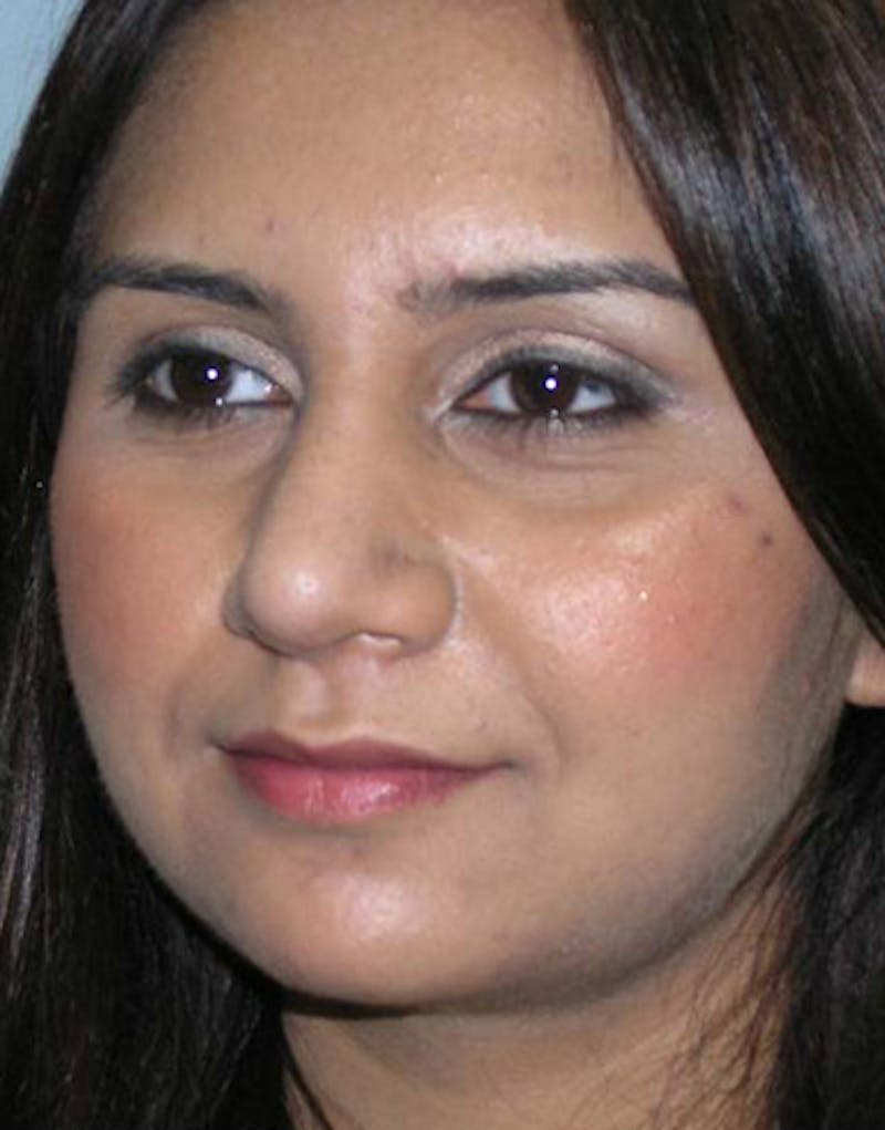 Rhinoplasty  Before & After Gallery - Patient 133931 - Image 8